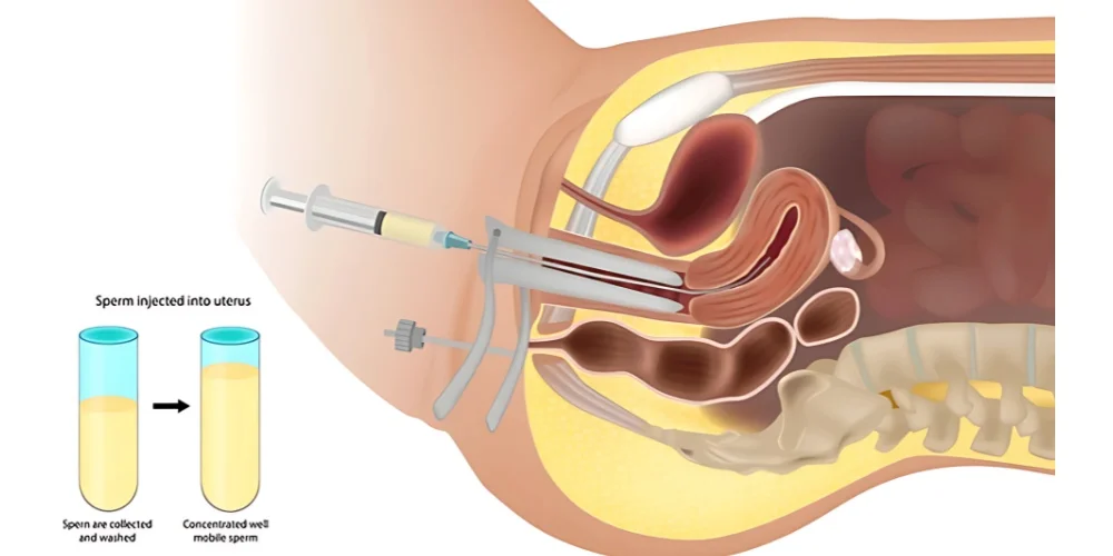 IUI Treatment
