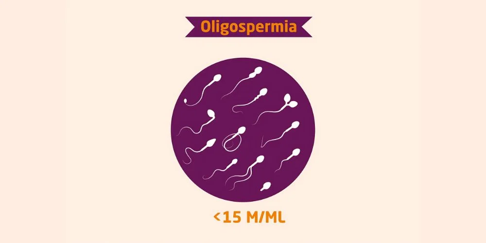 Oligospermia Treatment