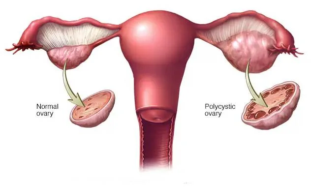 PCOS and PCOD treatment