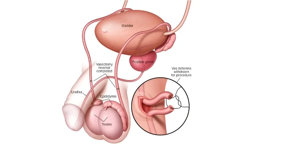 Vasectomy reversal