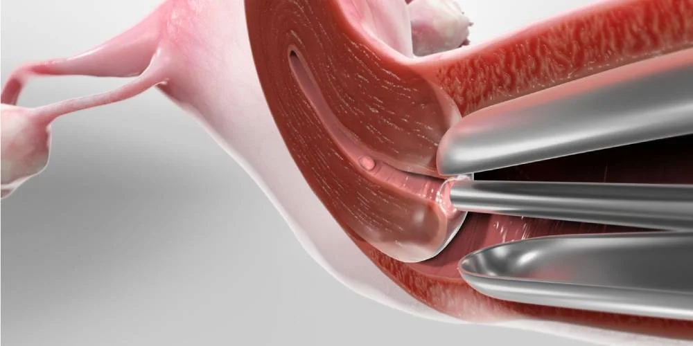 hysteroscopy