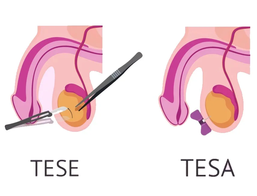 Micro TESE and TESA