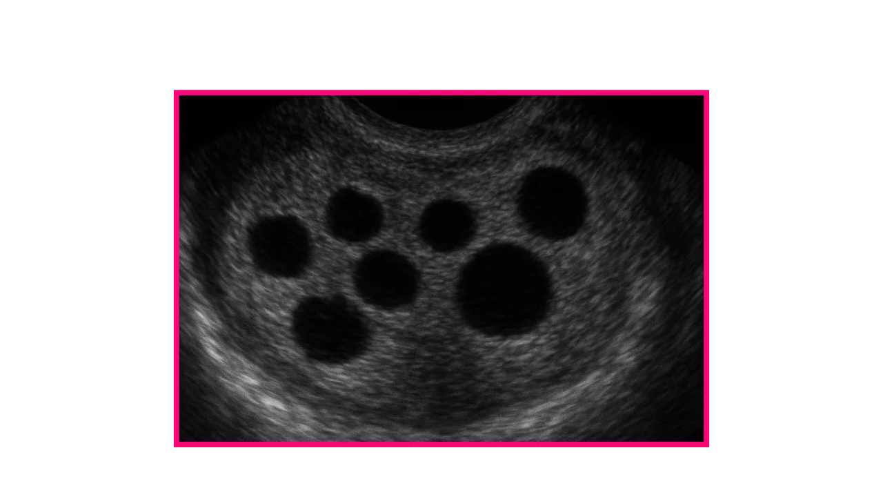 How Many Follicles Are Required for IVF?